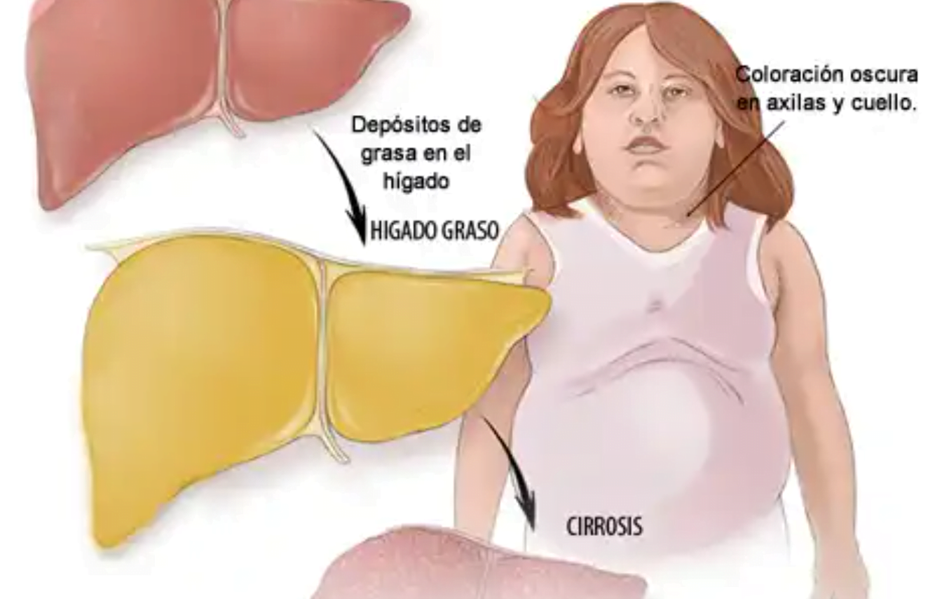 Investigan una nueva estrategia terapéutica para prevenir y combatir el hígado graso mediante modelos preclínicos