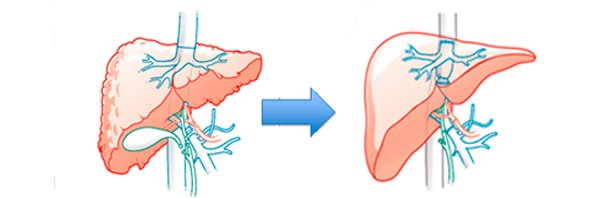 La lista de espera de trasplante hepático para pacientes con hepatitis C baja en un 75%