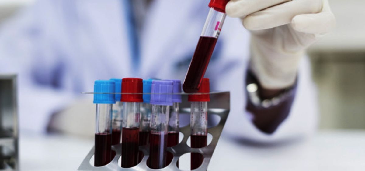 Desarrollan un análisis de sangre para predecir el riesgo de cáncer de hígado