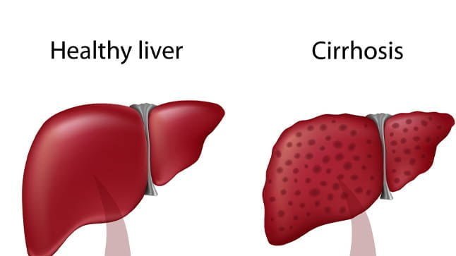 Factores asociados con la calidad de vida relacionada con la salud (CVRS) en los pacientes con cirrosis hepática