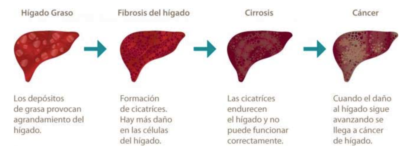 Los pacientes con cirrosis por hígado graso tienen un alto riesgo de complicaciones hepáticas graves y cáncer