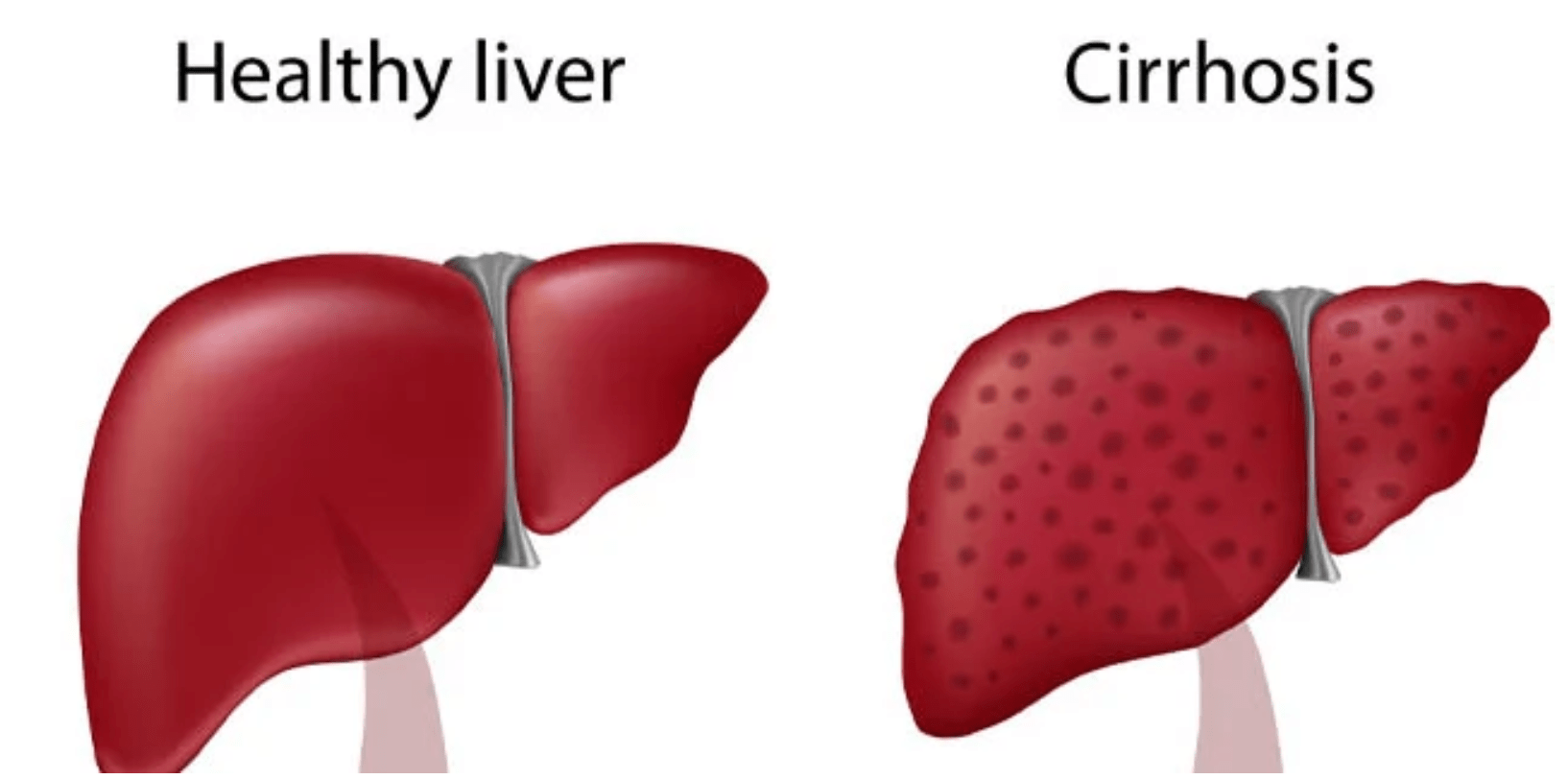 Quins factors provoquen la cirrosi hepàtica?