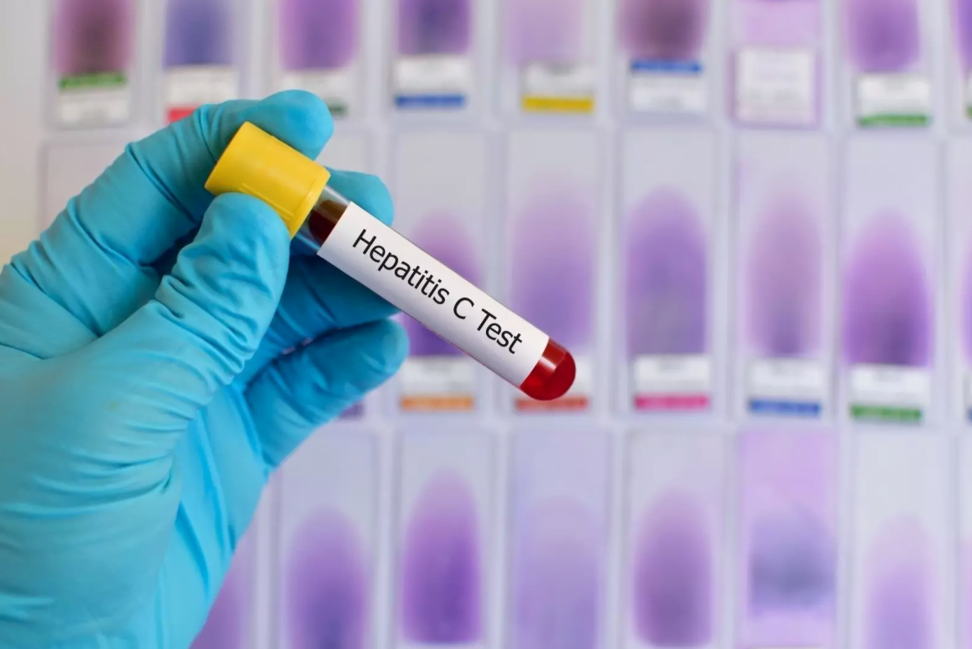Uno de cada cuatro pacientes con hepatitis viral crónica B o C se diagnostica de forma tardía