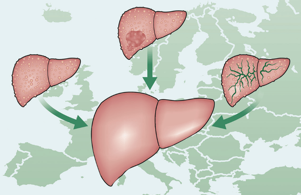 Un desafío urgente para Europa: de la lucha contra las enfermedades hepáticas a la prevención y protección del hígado