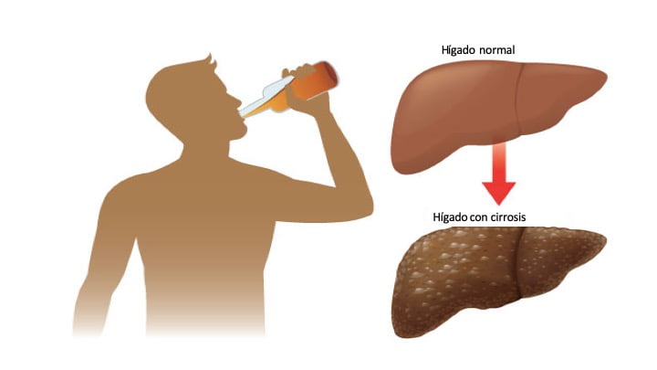 El estigma asociado a la enfermedad hepática por consumo excesivo de alcohol y su impacto en la atención médica