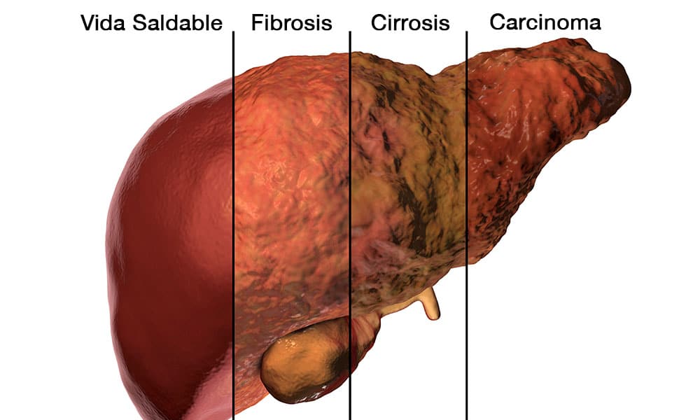La fibrosis avanzada en personas con NAFLD aumenta el riesgo de complicaciones hepáticas