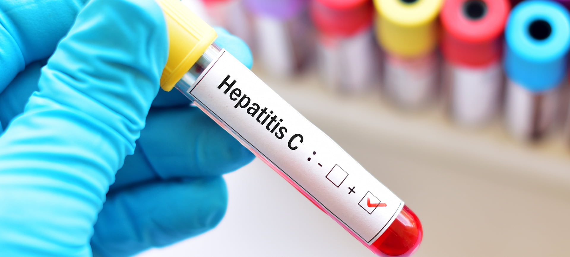 Eliminación de la hepatitis C: menos del 25% de las personas con hepatitis C en el mundo están diagnosticadas