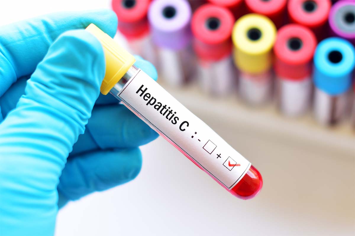 La búsqueda activa, esencial para el diagnóstico precoz ante la hepatitis C en usuarios de drogas