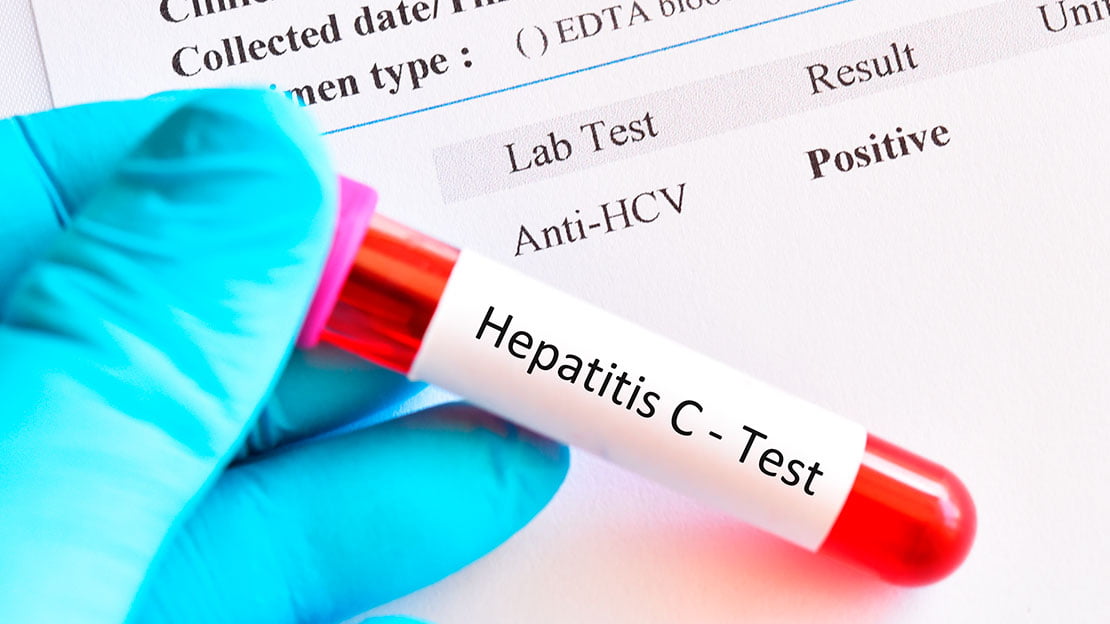 Las pruebas de hepatitis C en las farmacias comunitarias mejoran la aceptación de las pruebas y el tratamiento